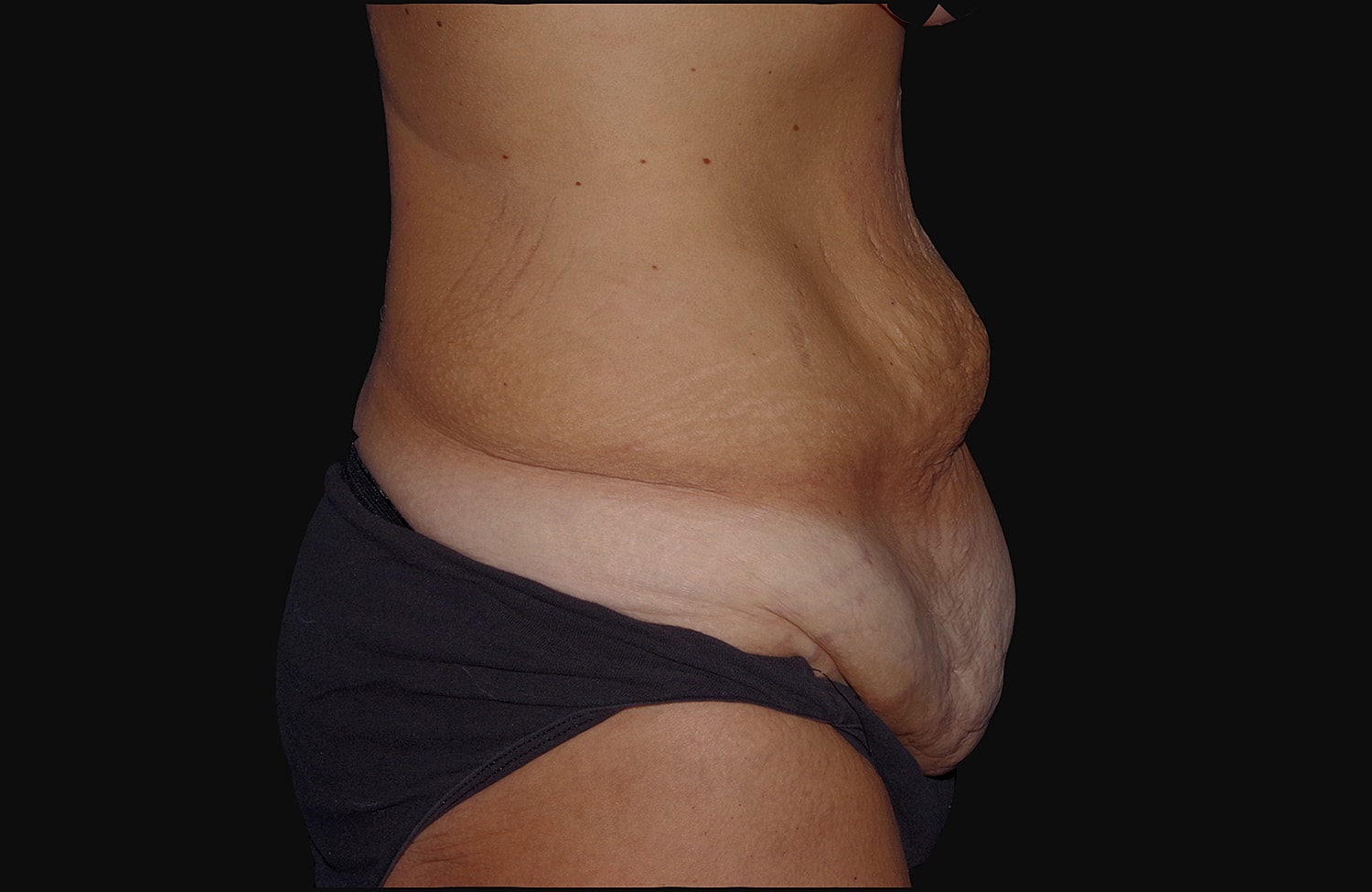 Tummy Tuck Before & After