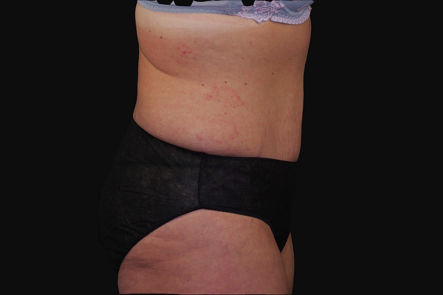 Tummy Tuck Before & After