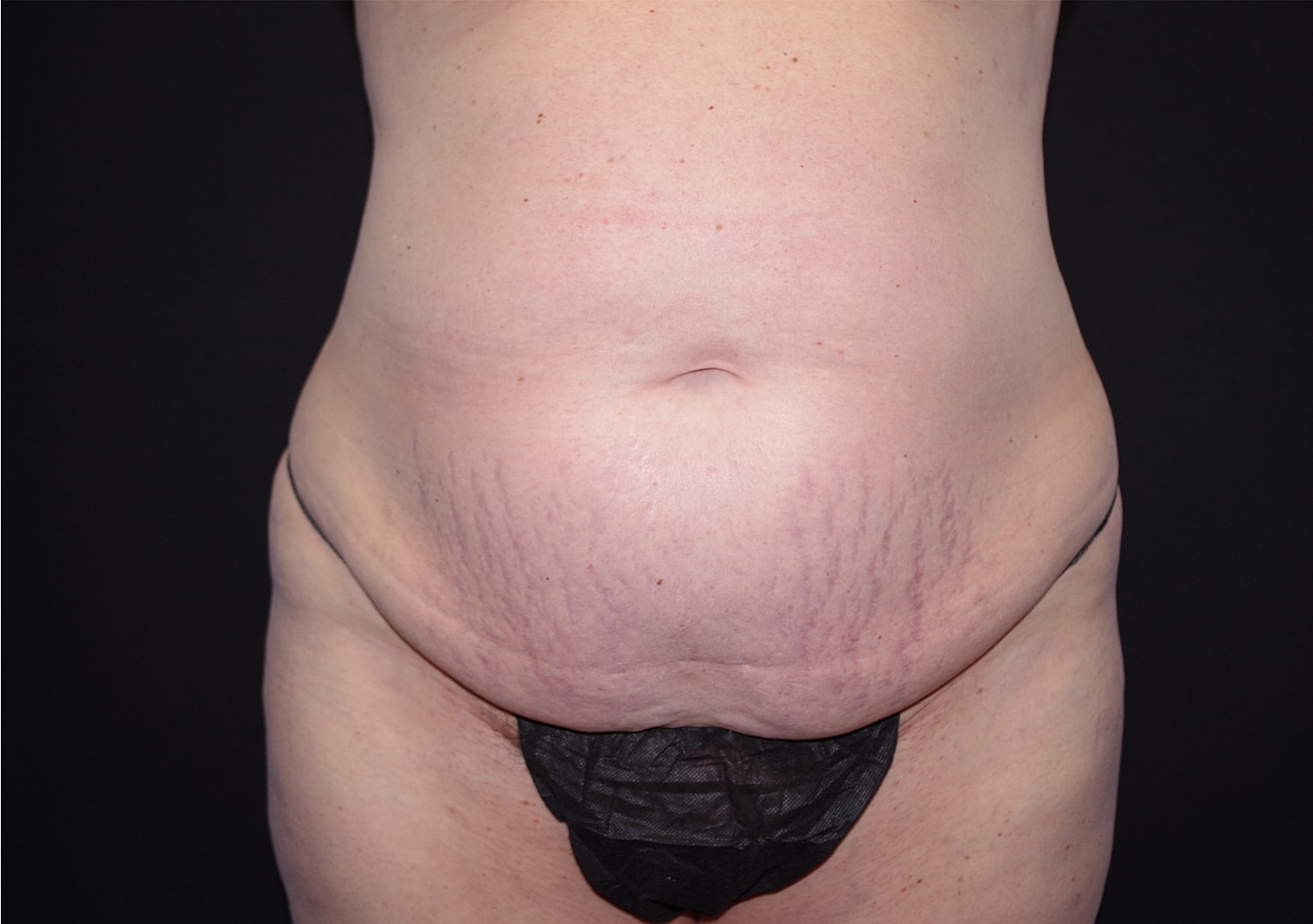 Tummy Tuck Before & After