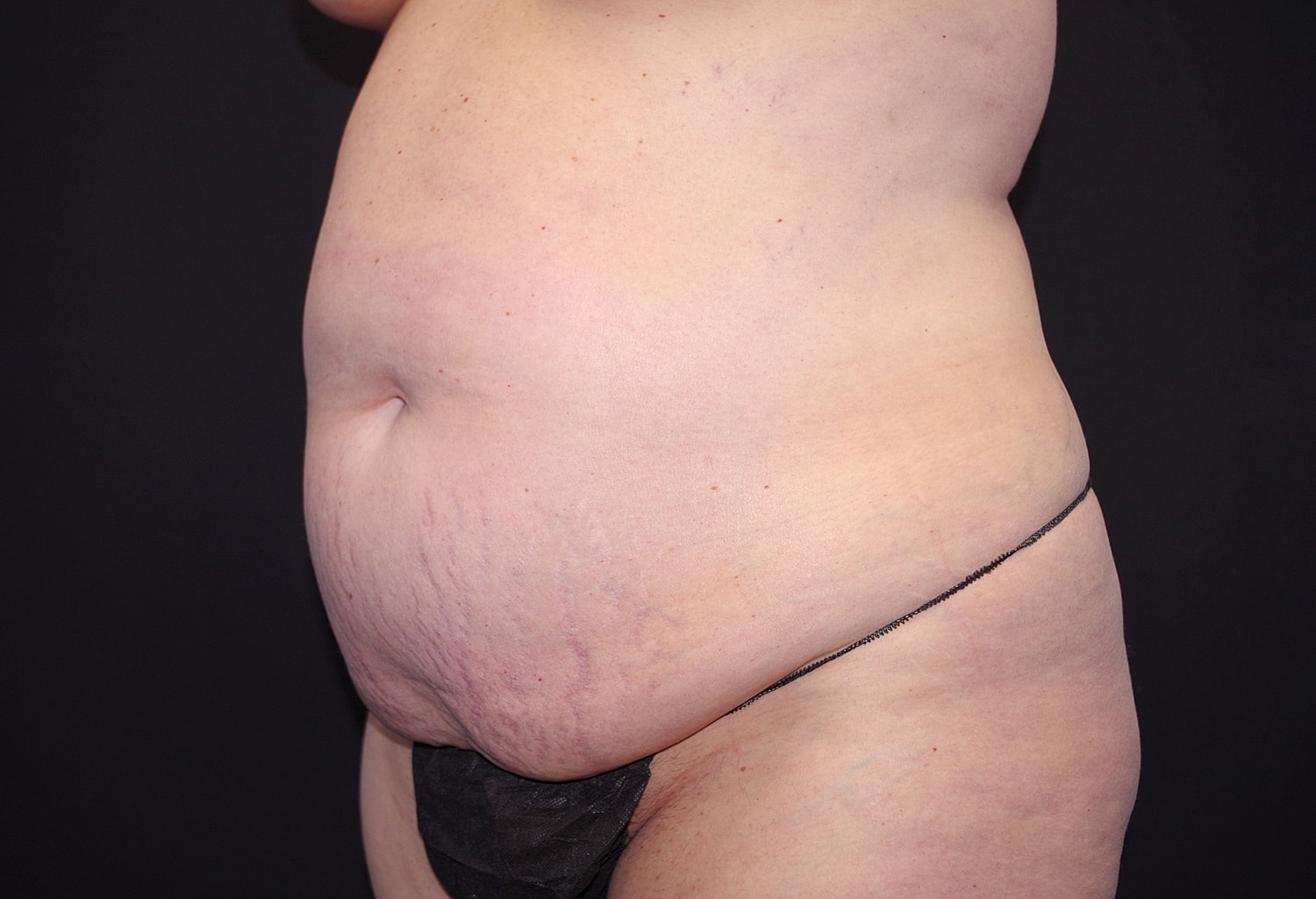 Tummy Tuck Before & After