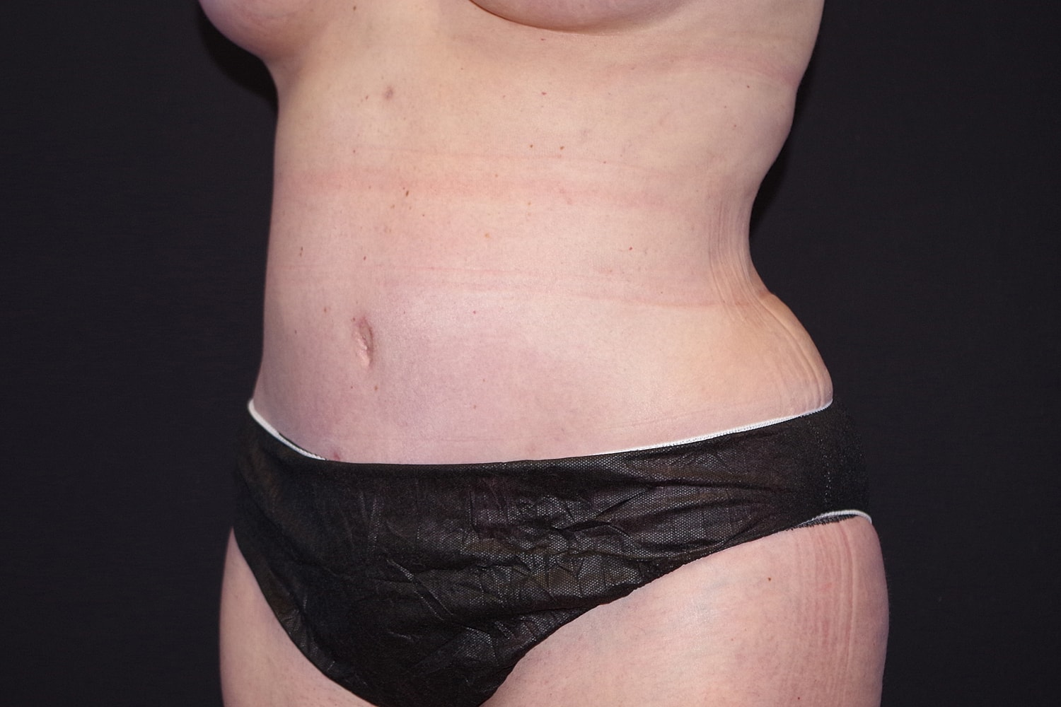 Tummy Tuck Before & After