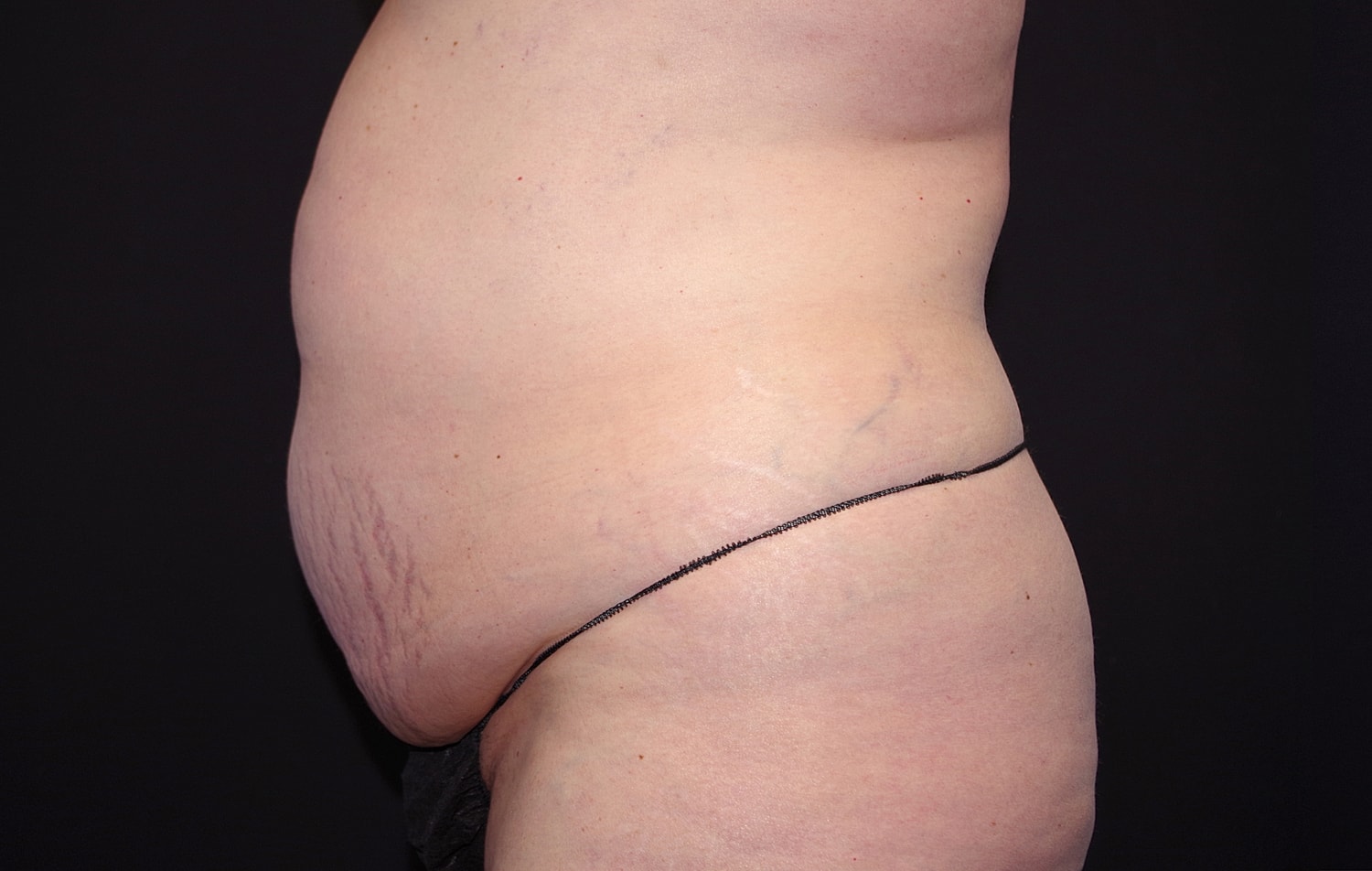 Tummy Tuck Before & After