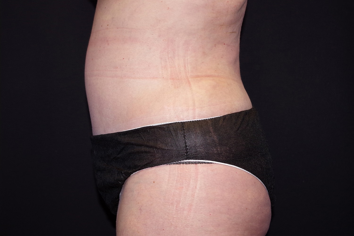 Tummy Tuck Before & After