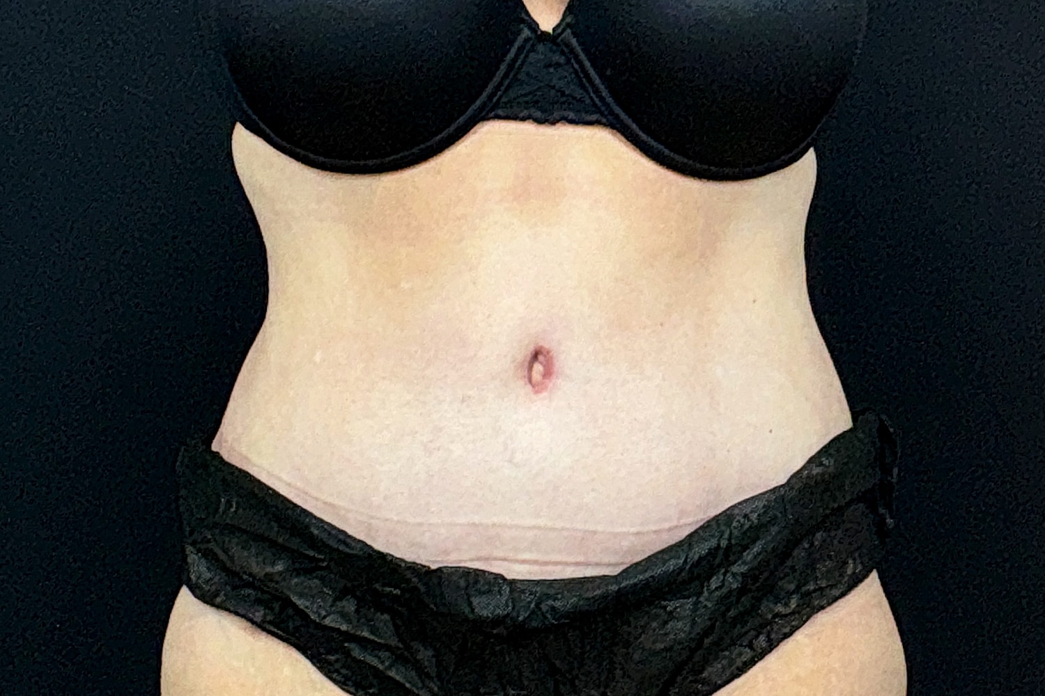 Tummy Tuck Before & After