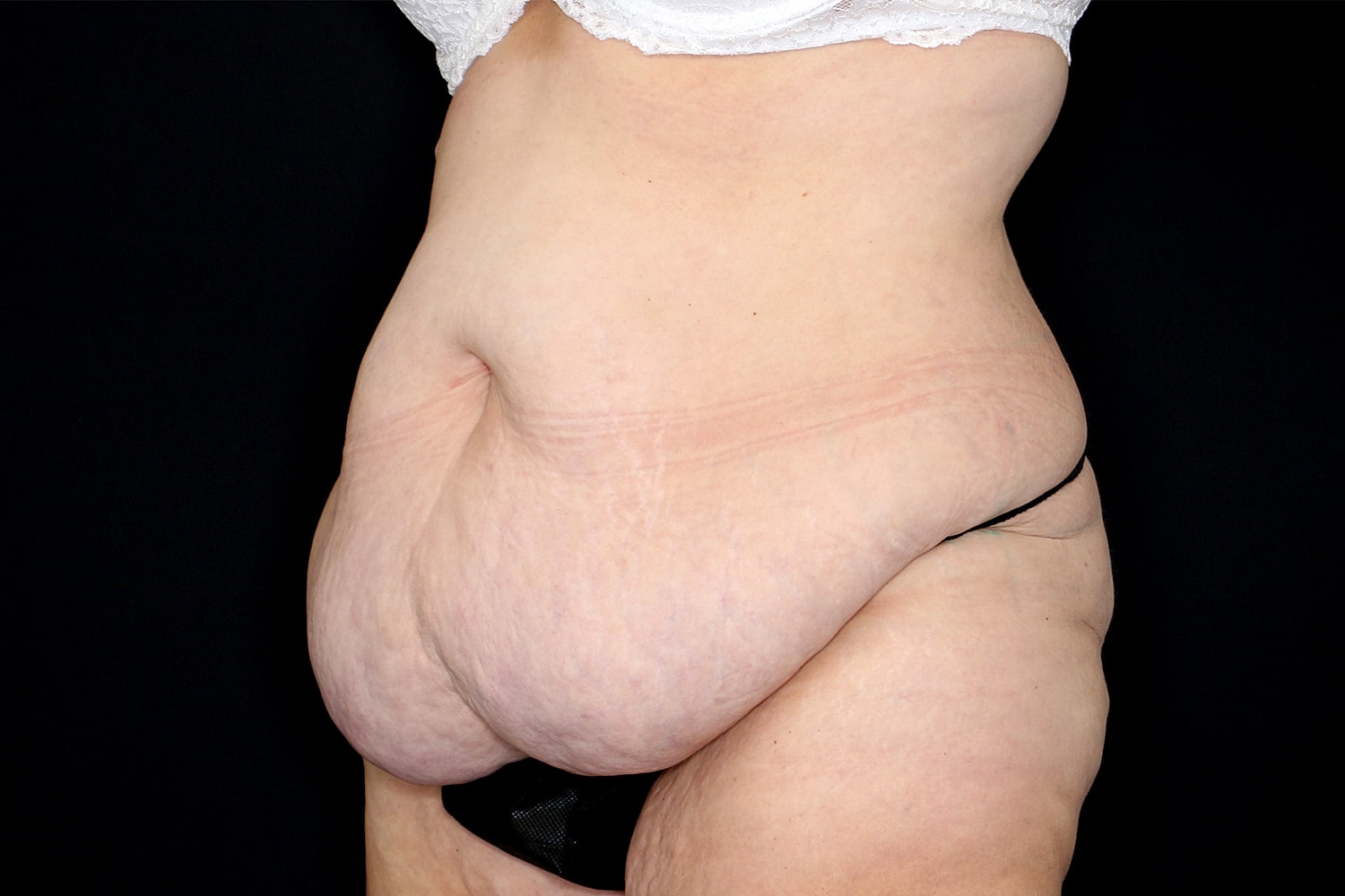 Tummy Tuck Before & After