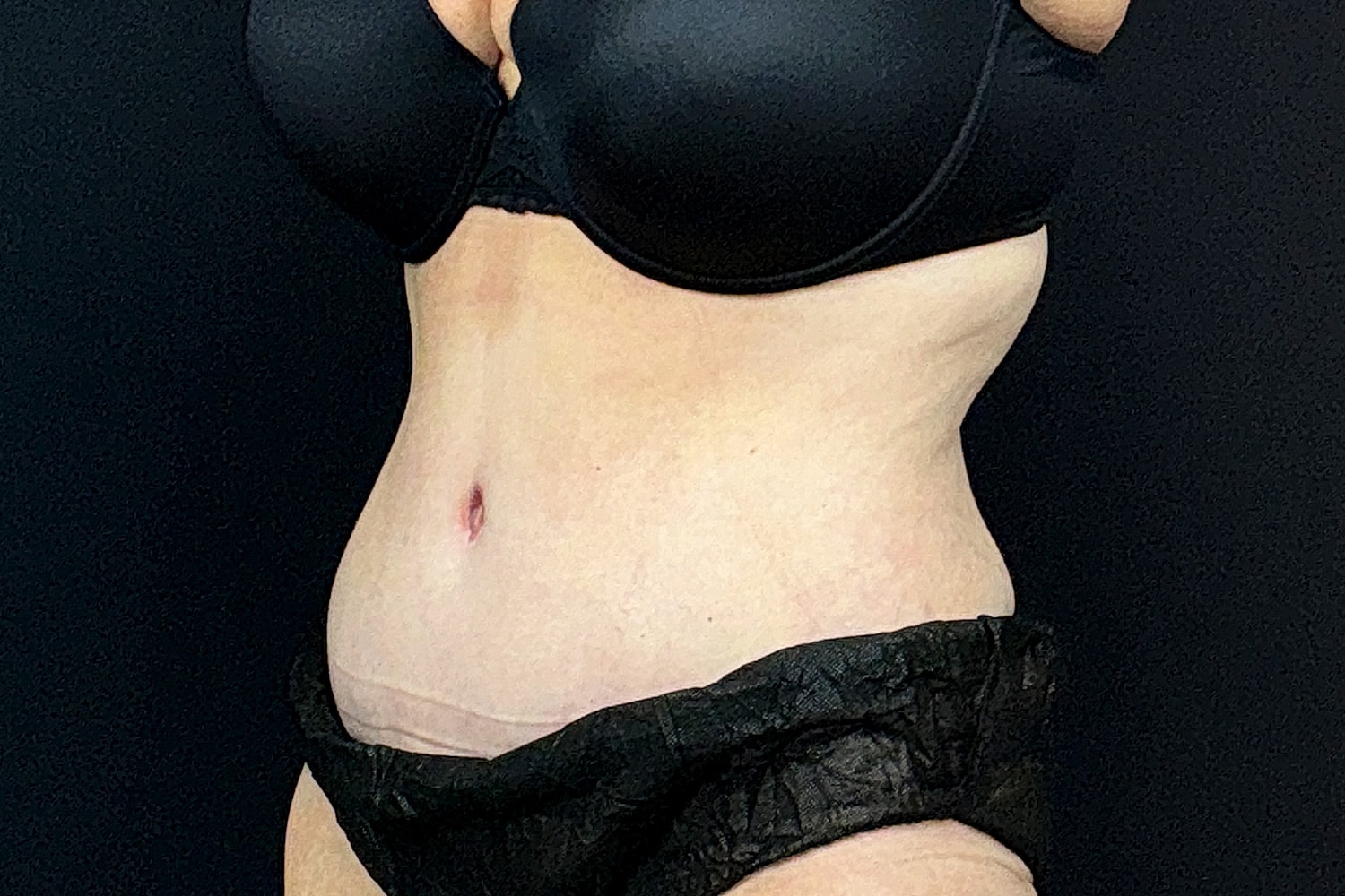 Tummy Tuck Before & After