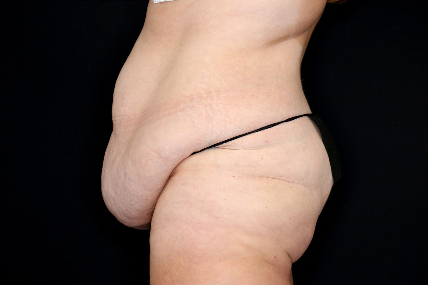 Tummy Tuck Before & After