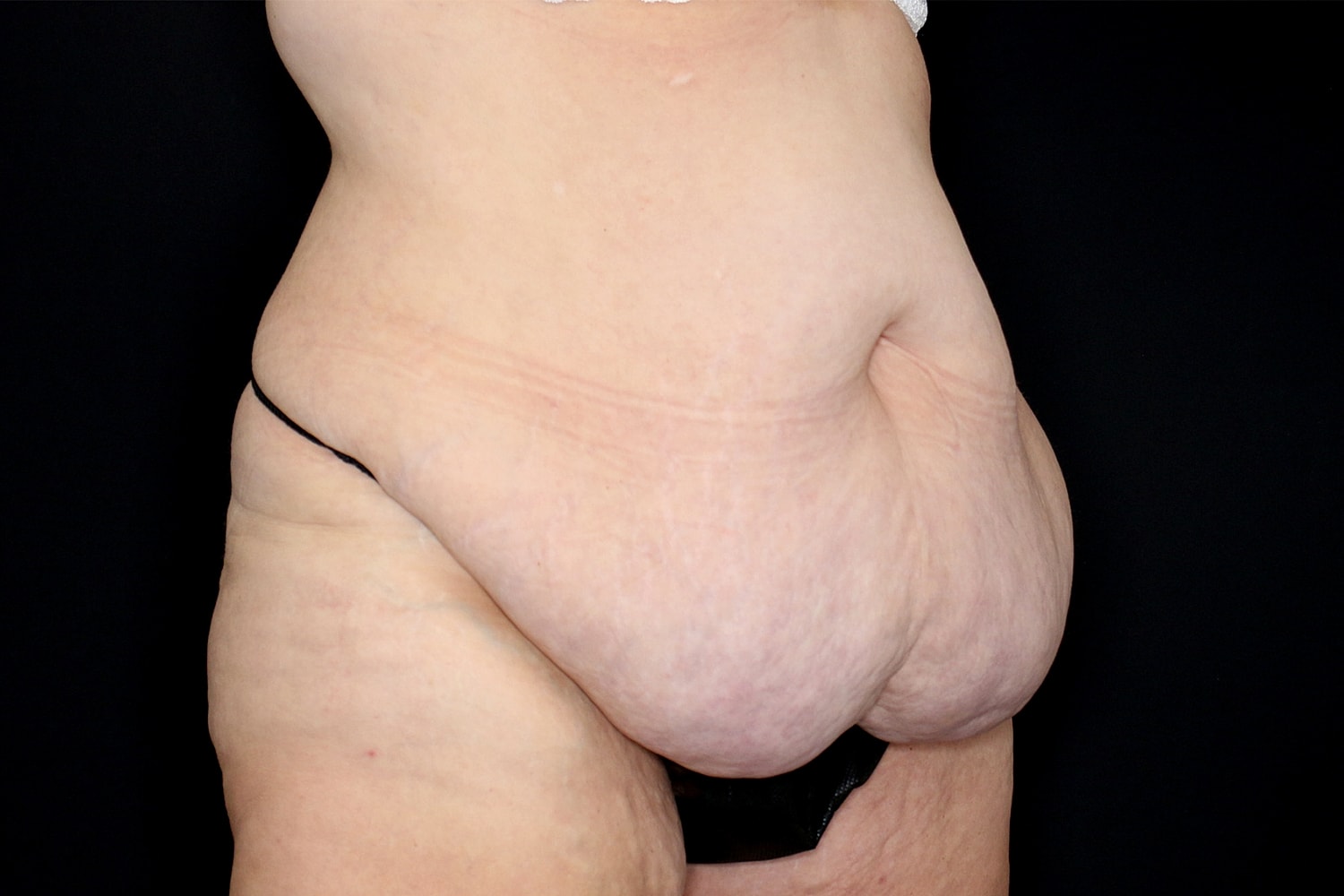 Tummy Tuck Before & After