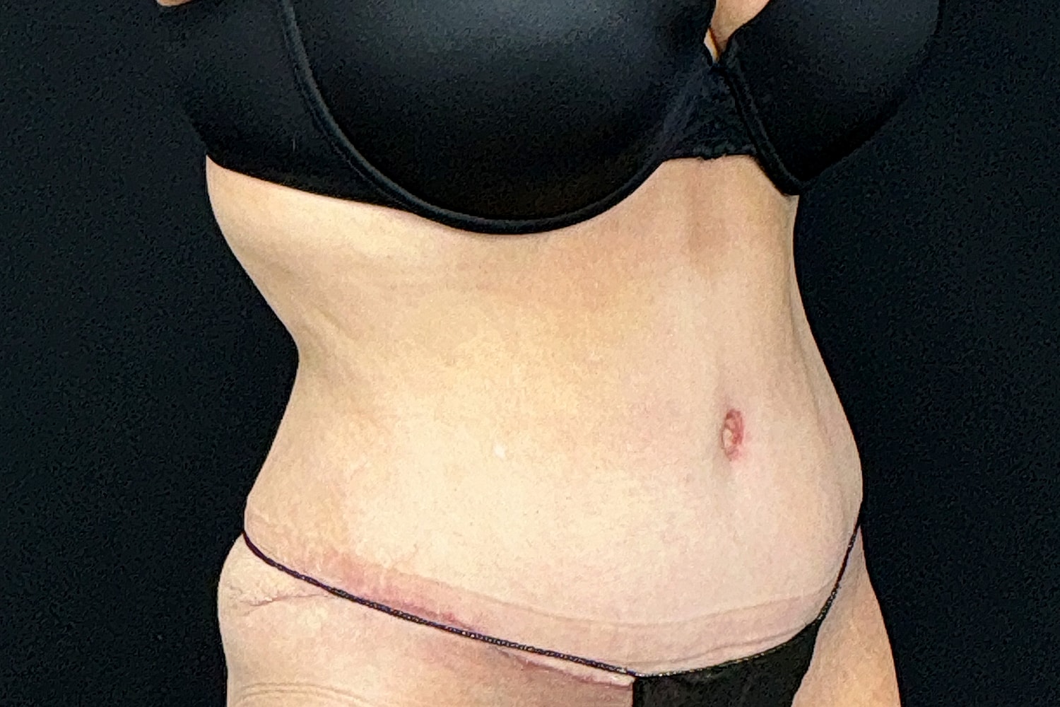 Tummy Tuck Before & After