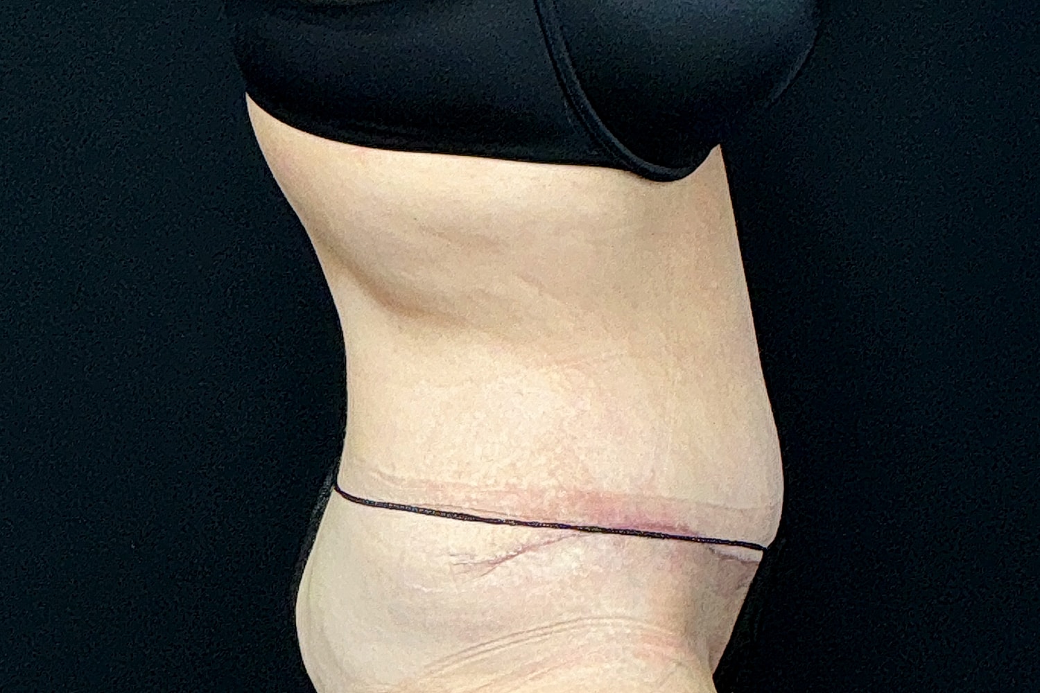 Tummy Tuck Before & After