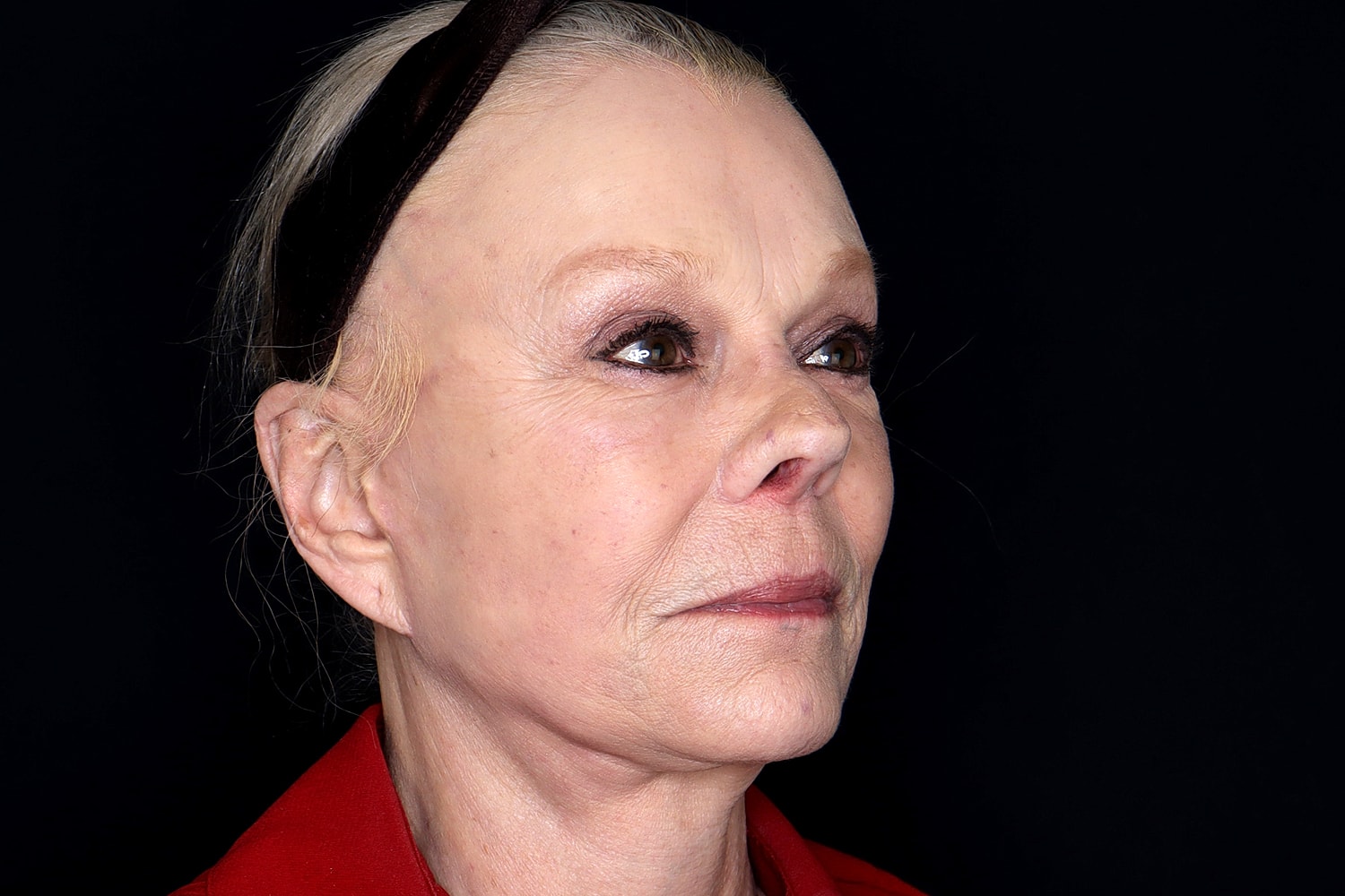 Brow Lift Before & After