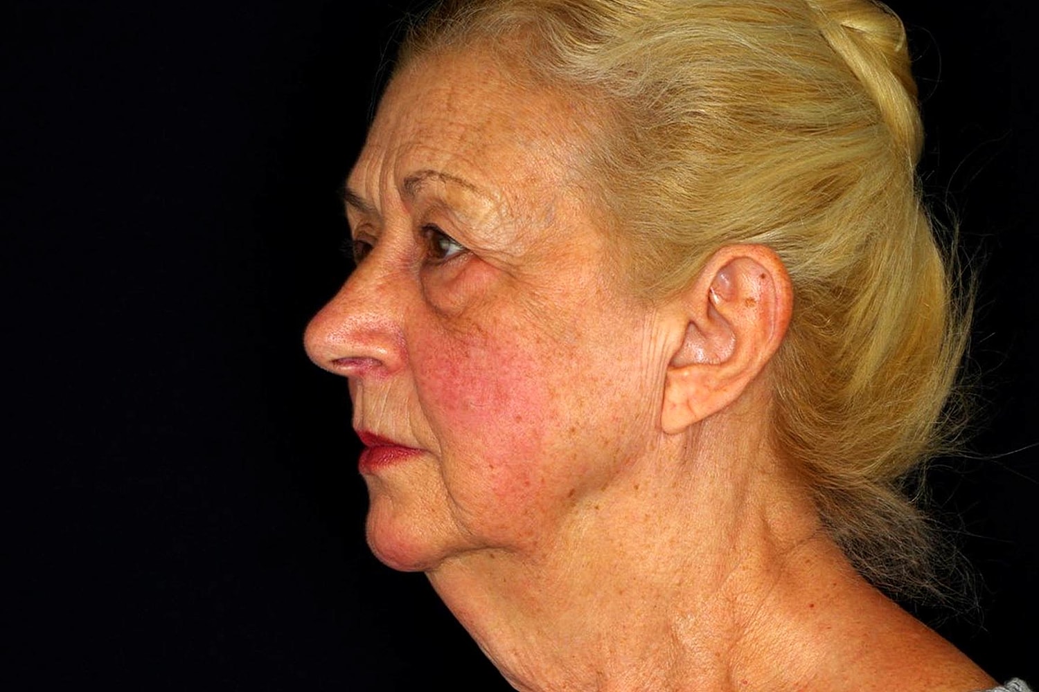Brow Lift Before & After