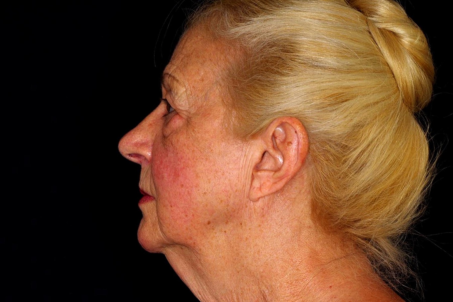 Brow Lift Before & After