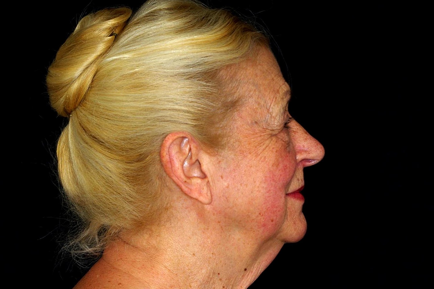 Brow Lift Before & After