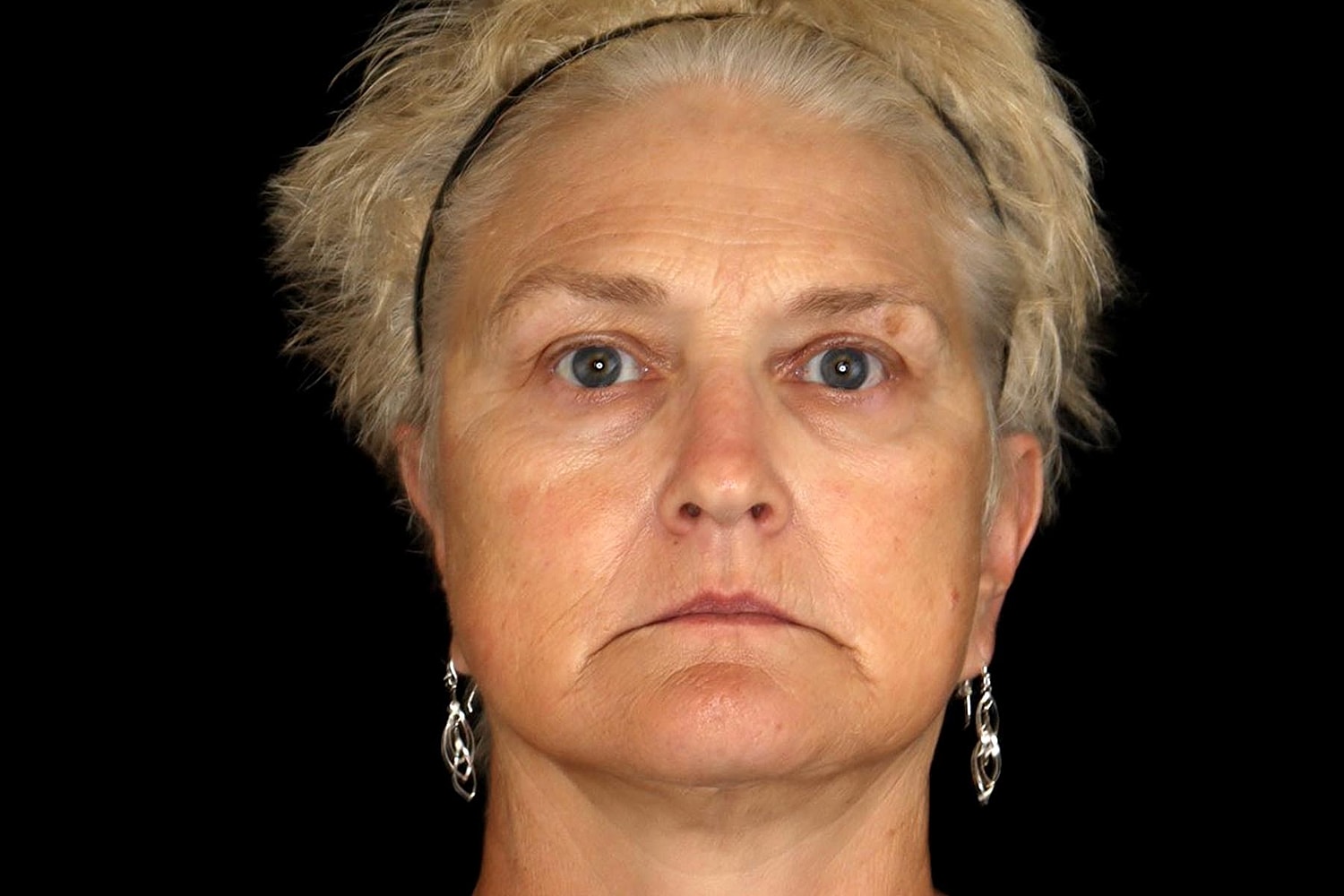 Brow Lift Before & After