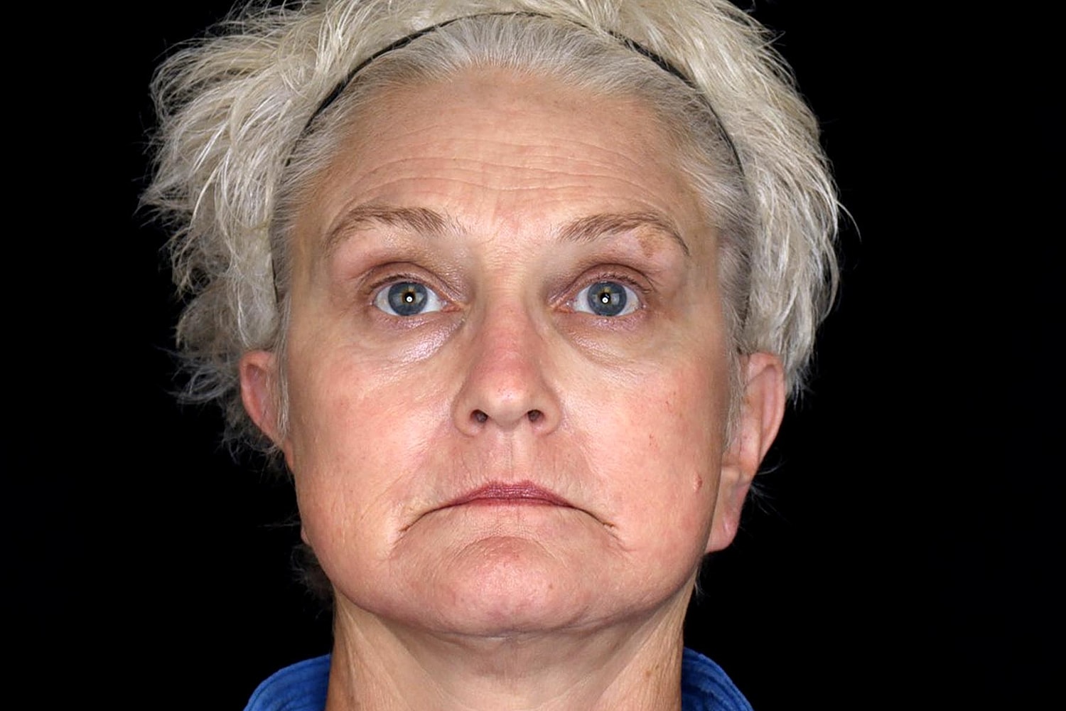 Brow Lift Before & After