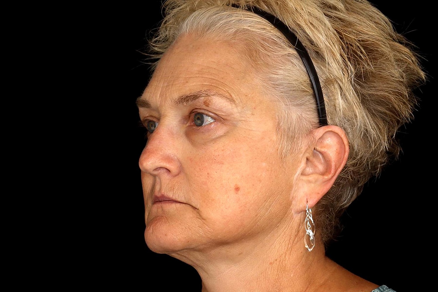 Brow Lift Before & After