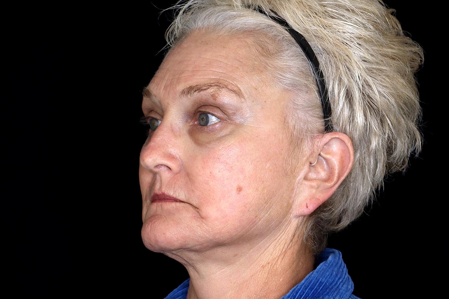 Brow Lift Before & After