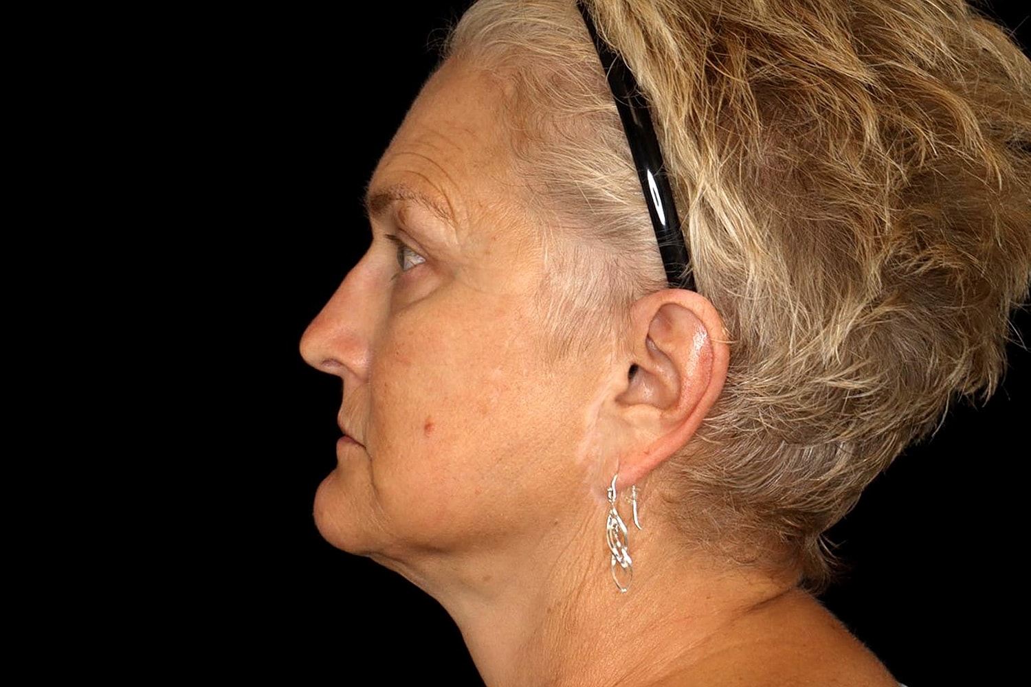 Brow Lift Before & After