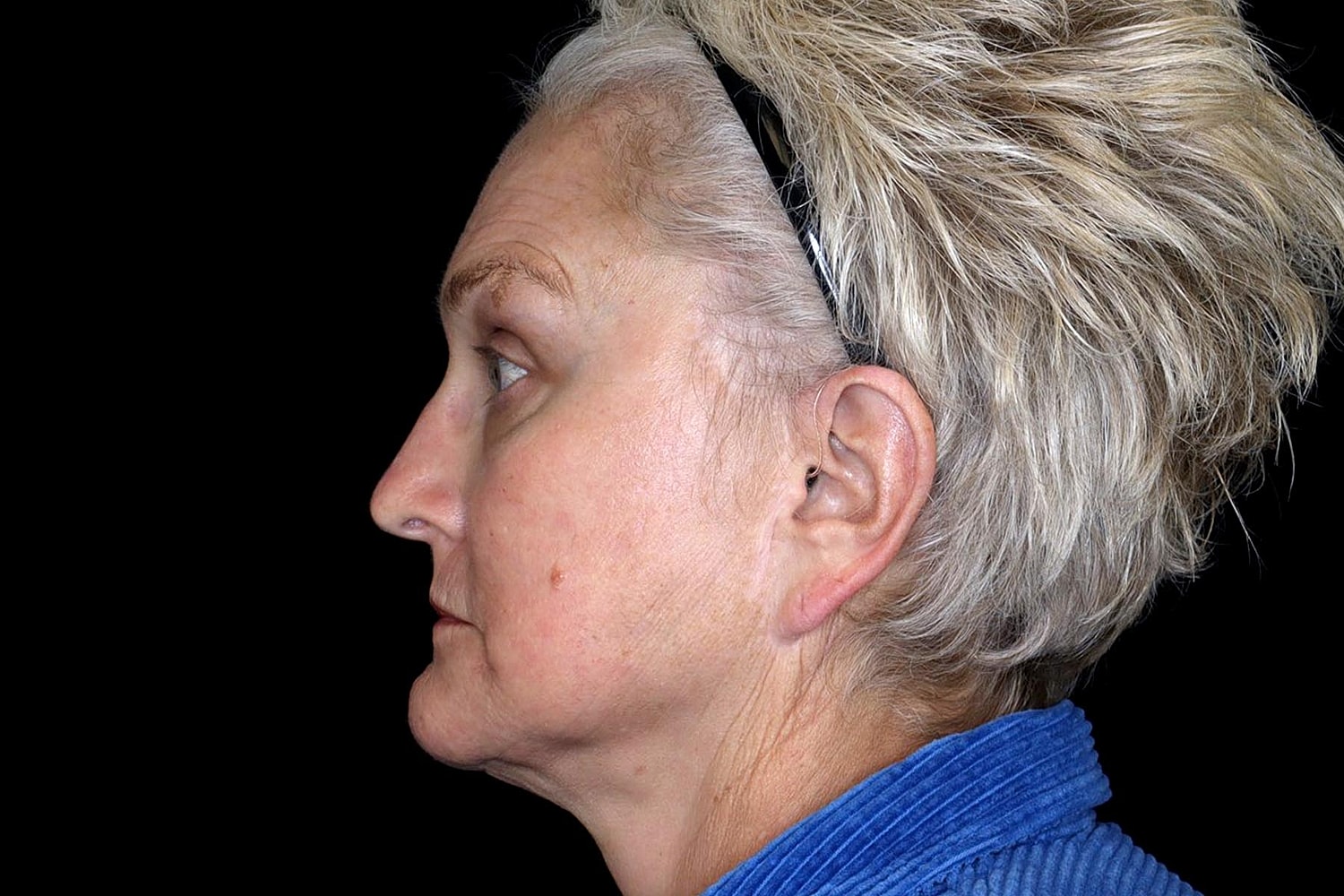 Brow Lift Before & After
