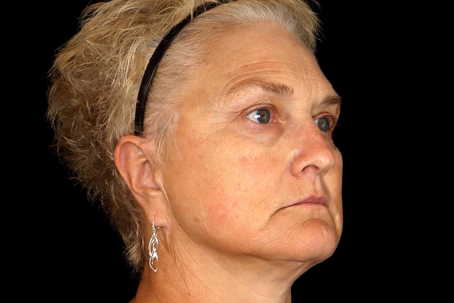Brow Lift Before & After