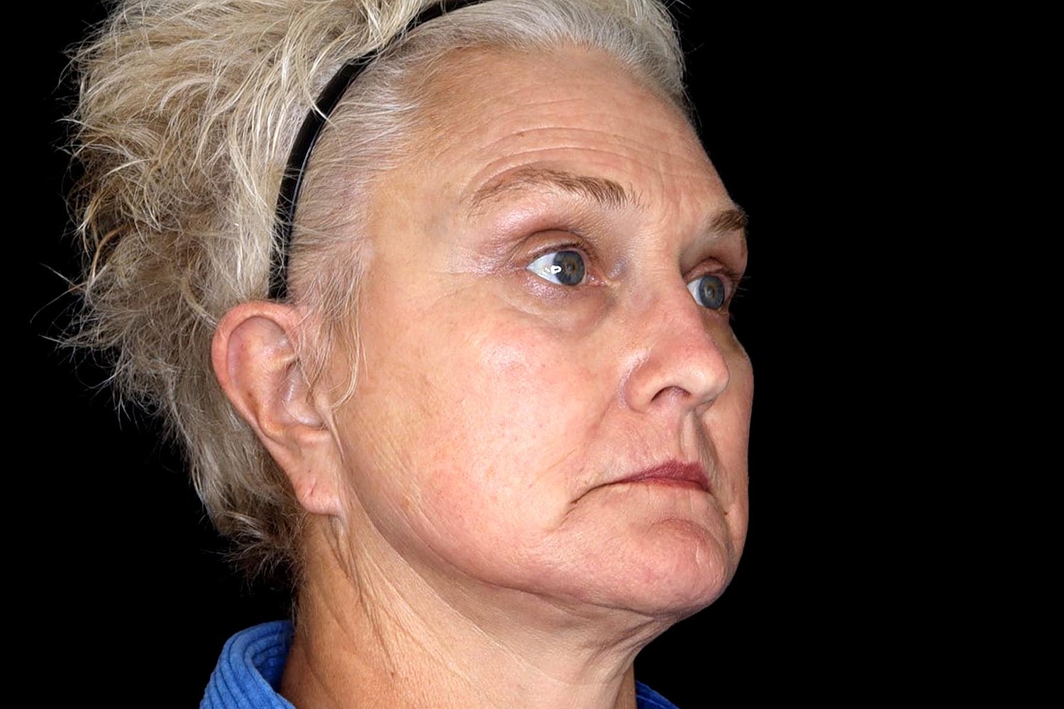 Brow Lift Before & After