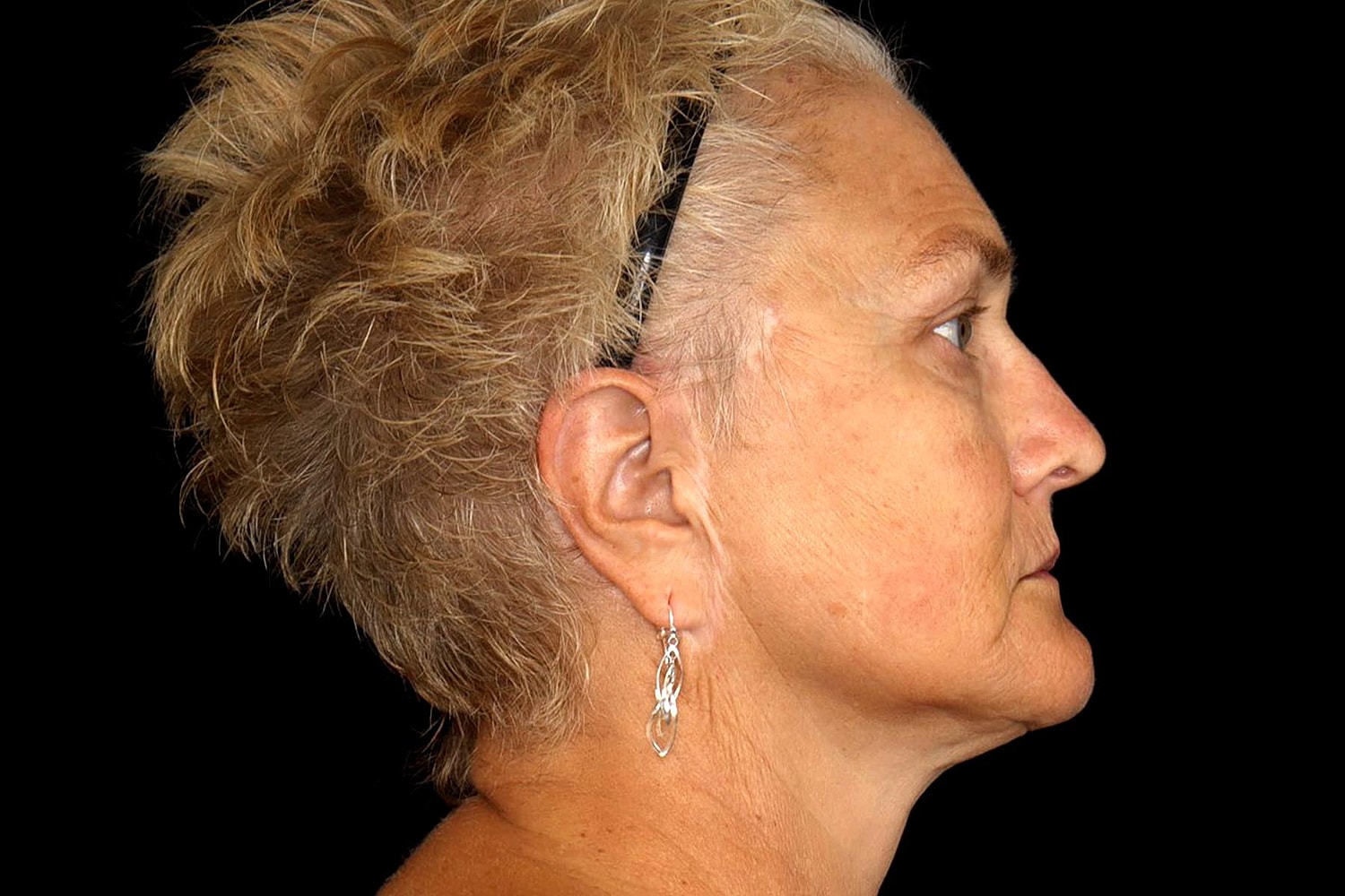 Brow Lift Before & After