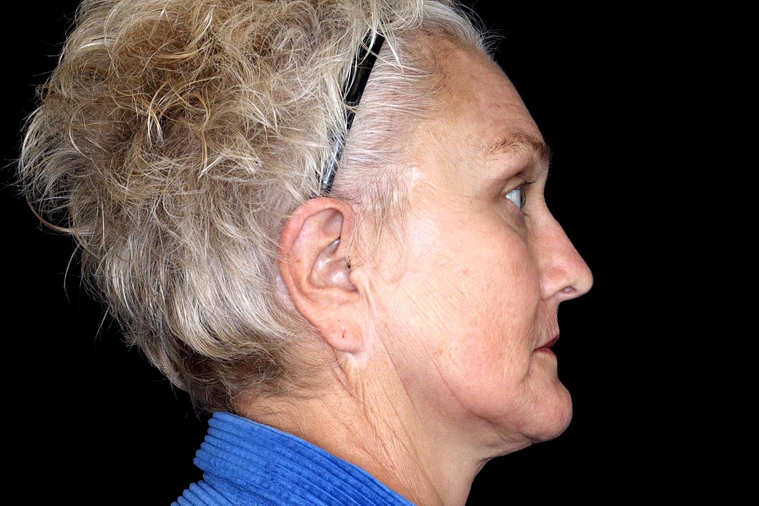Brow Lift Before & After