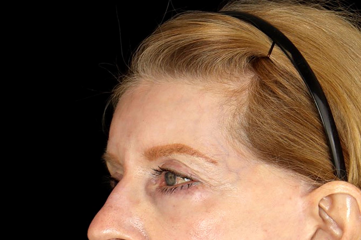 Brow Lift Before & After