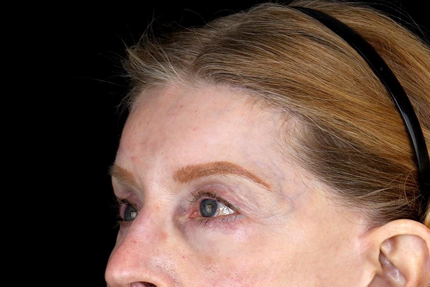 Brow Lift Before & After