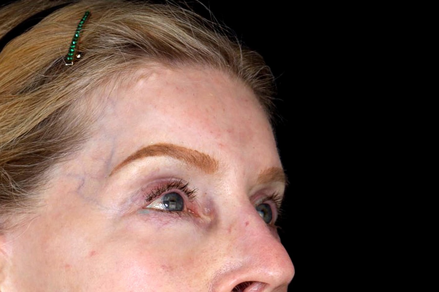 Brow Lift Before & After