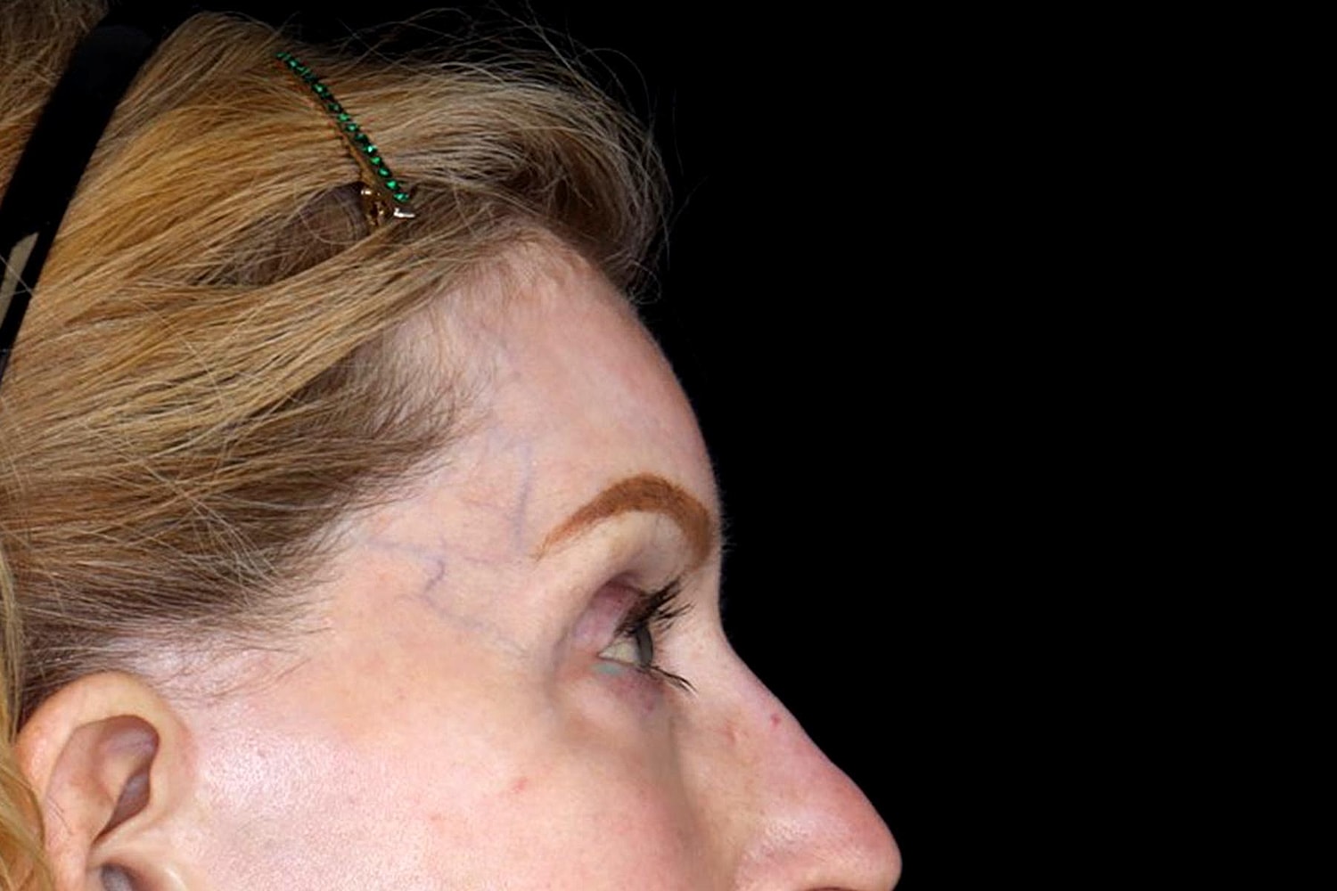 Brow Lift Before & After