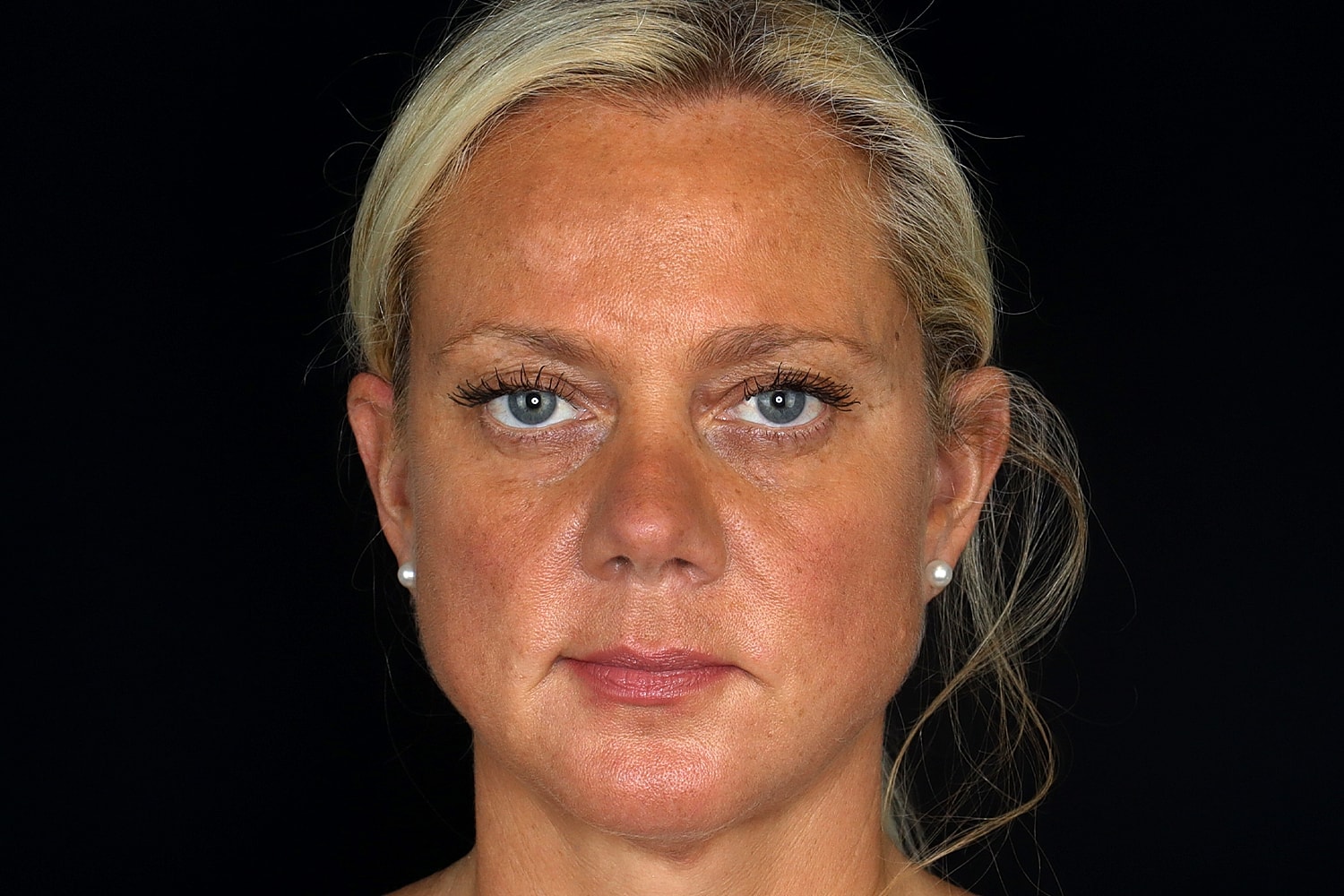 Brow Lift Before & After