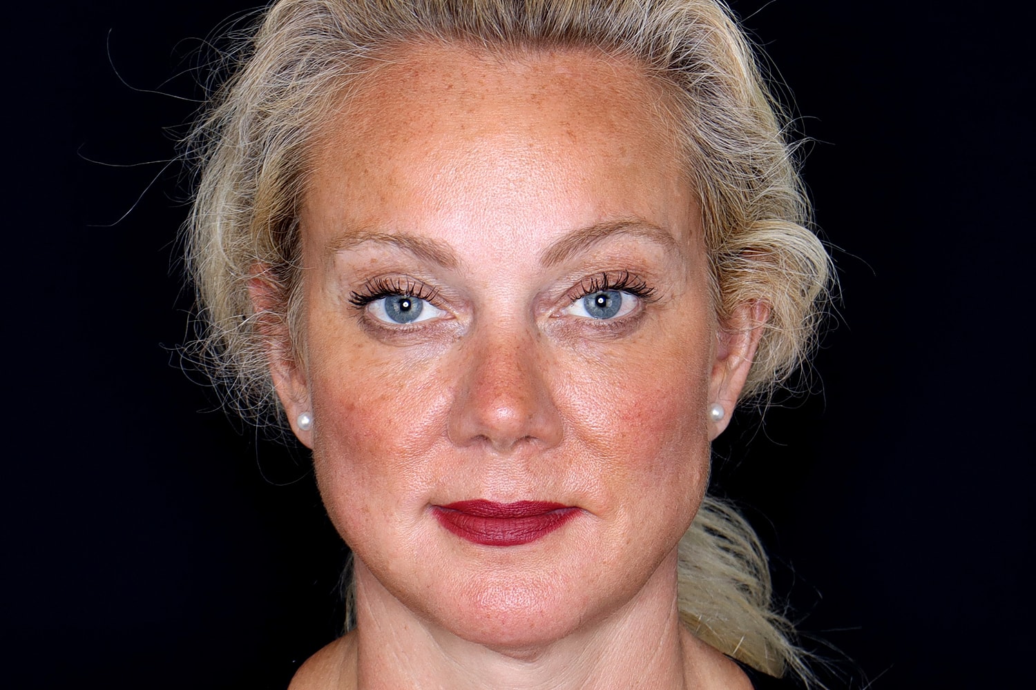 Brow Lift Before & After