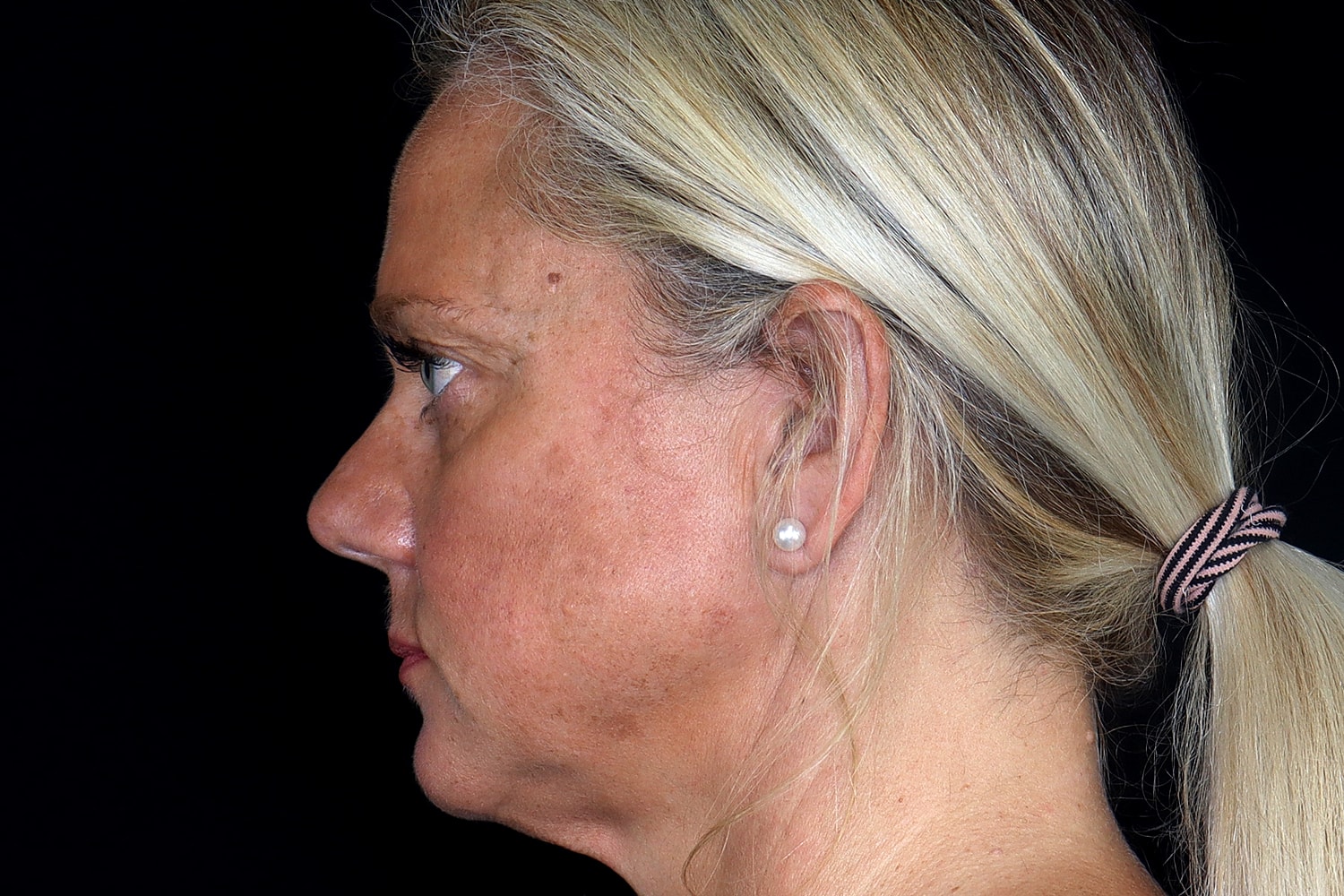 Brow Lift Before & After