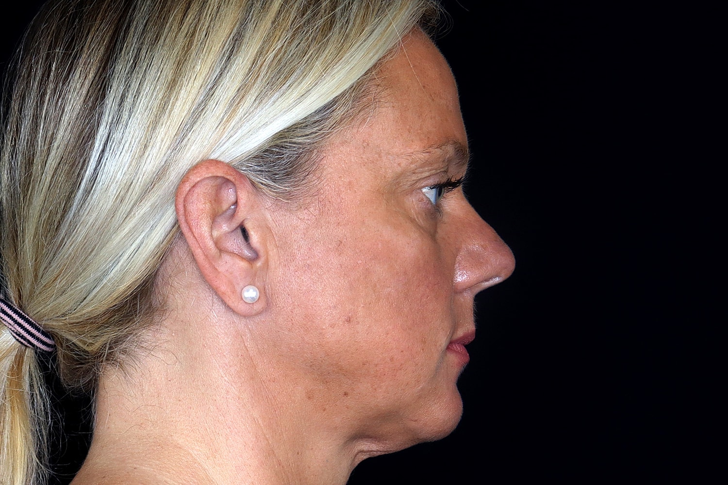 Brow Lift Before & After