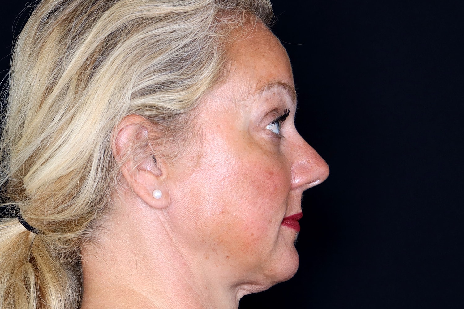 Brow Lift Before & After