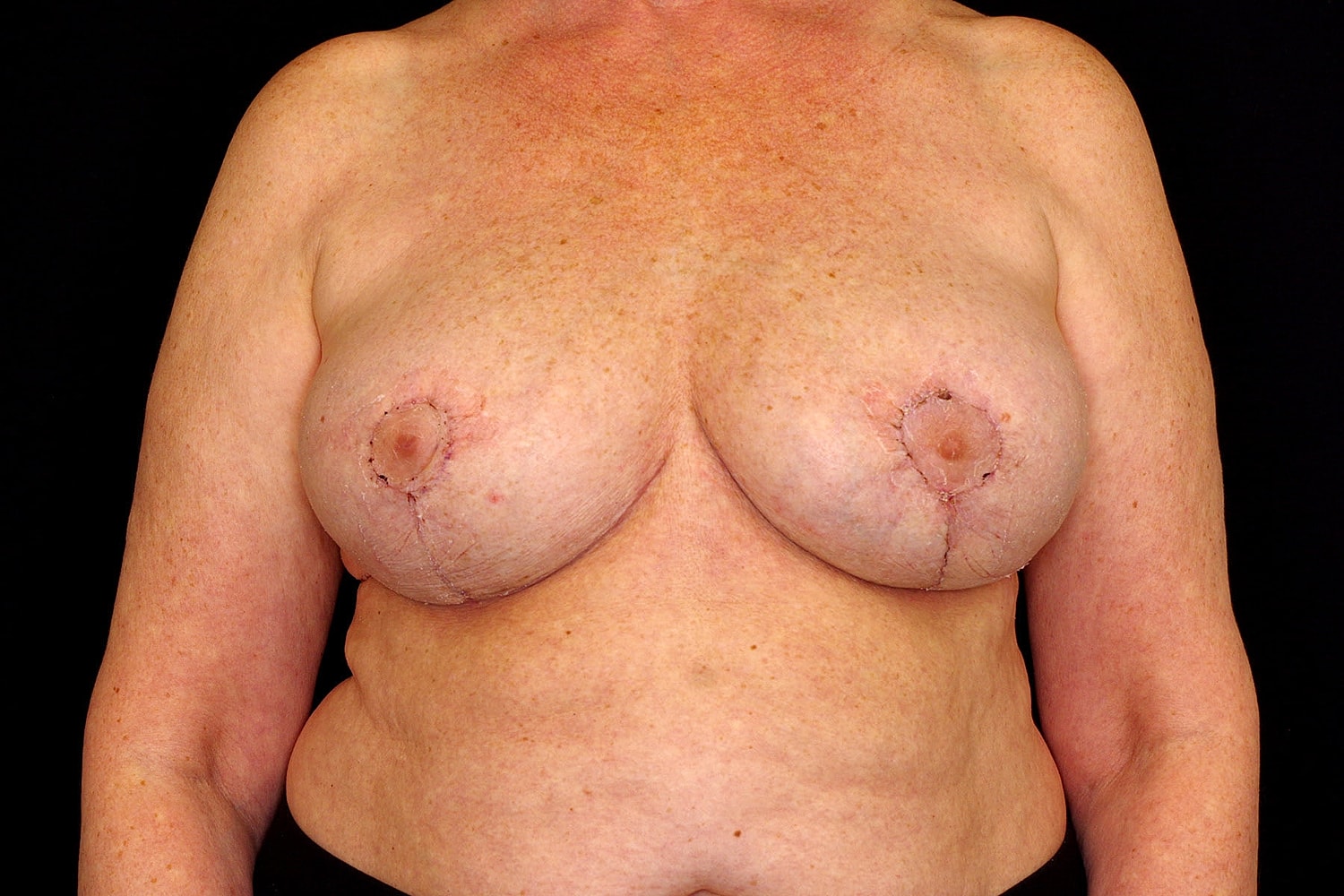 Breast Implant Removal Before & After