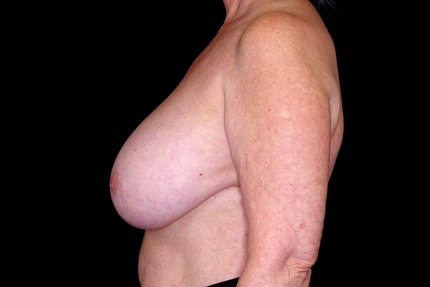 Breast Implant Removal Before & After