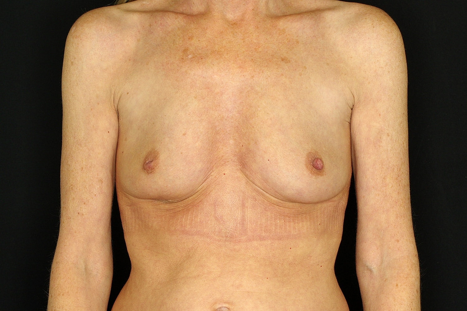 Breast Implant Removal Before & After