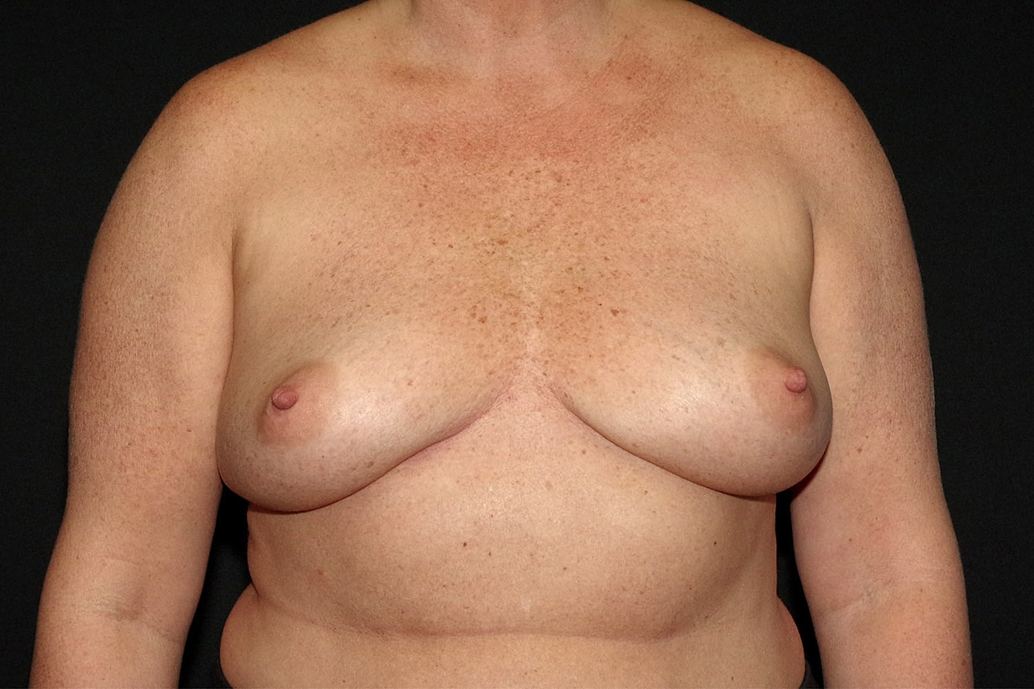 Breast Implant Removal Before & After