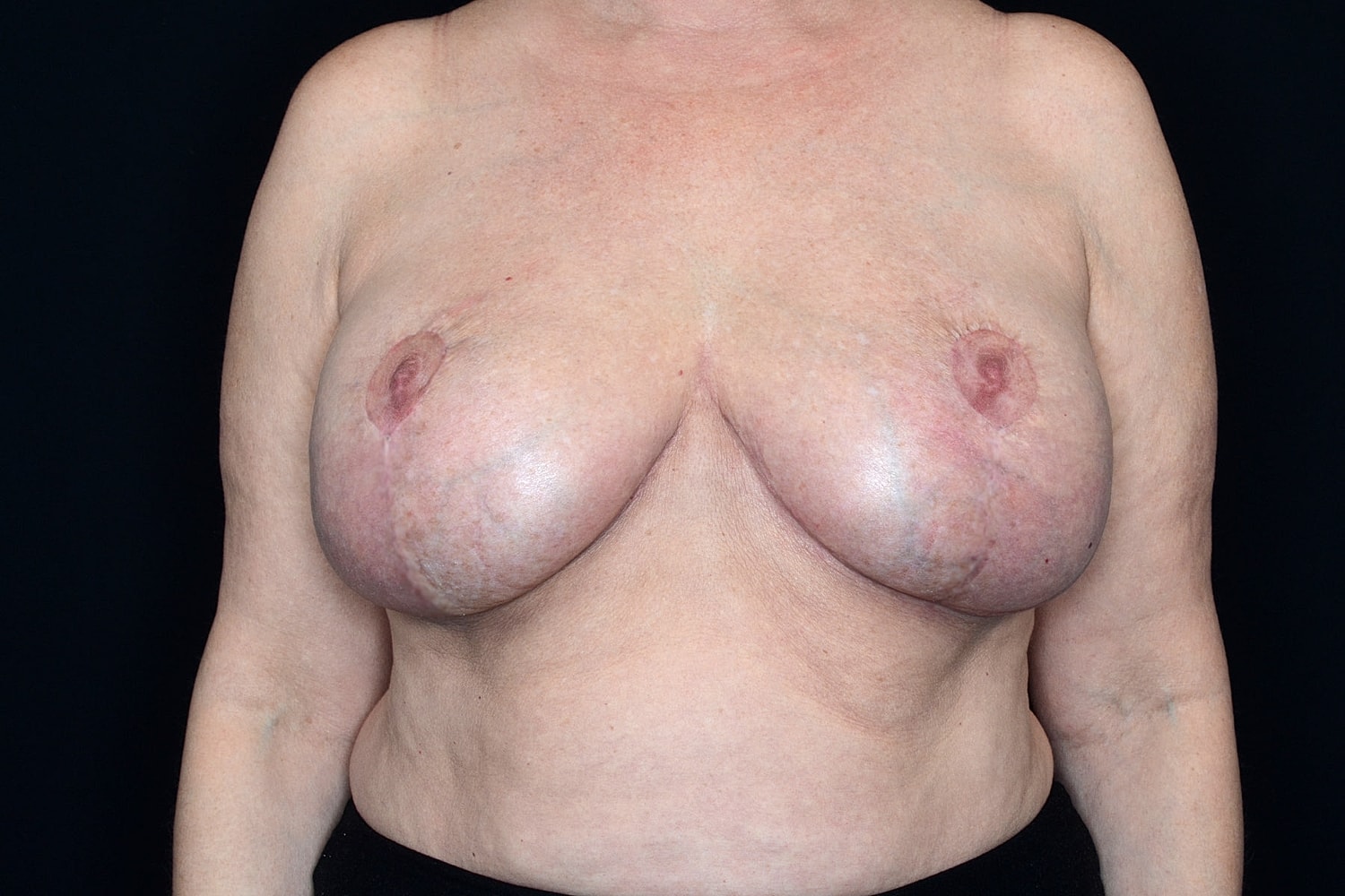 Breast Implant Removal Before & After