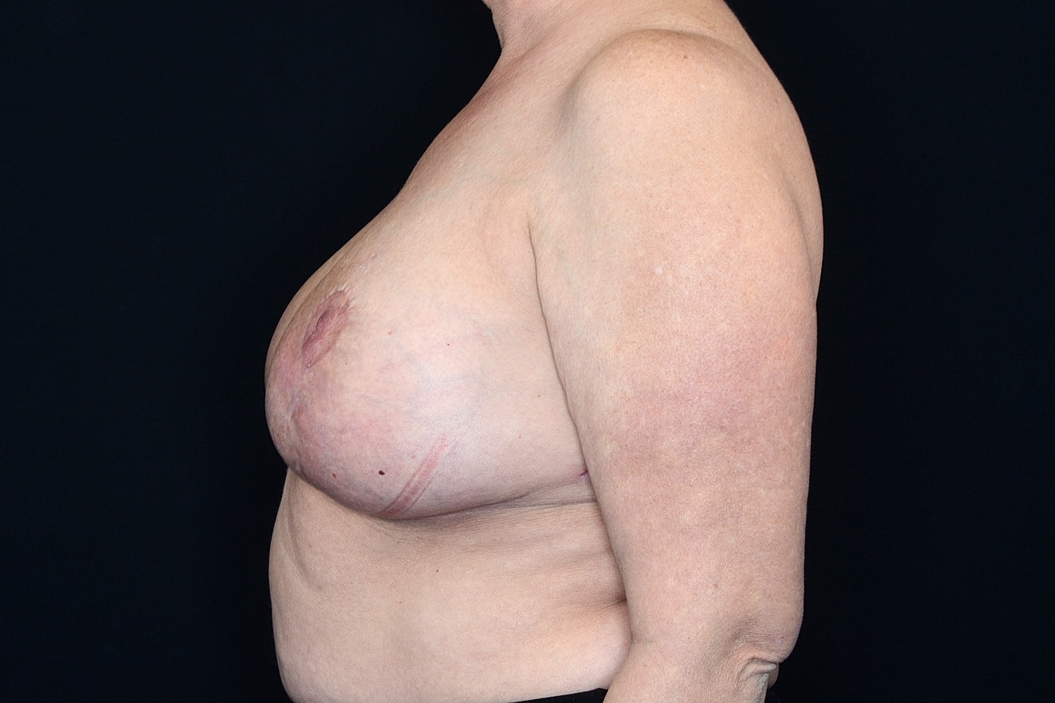 Breast Implant Removal Before & After