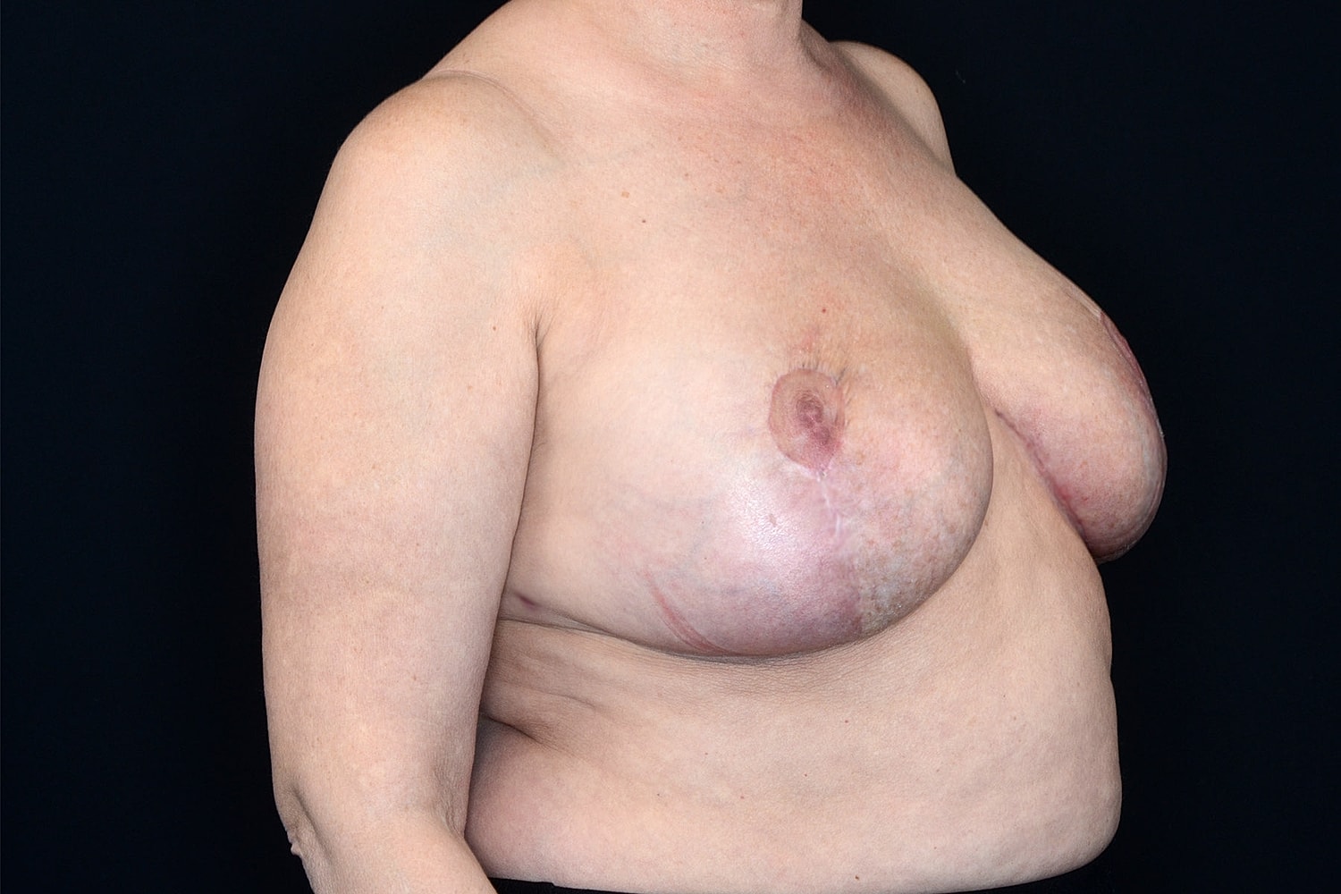 Breast Implant Removal Before & After