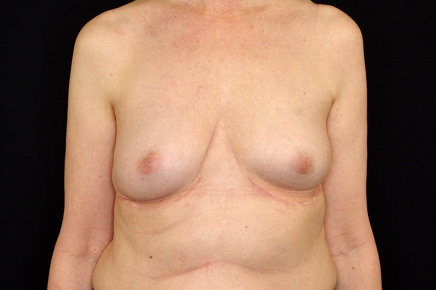 Breast Implant Removal Before & After