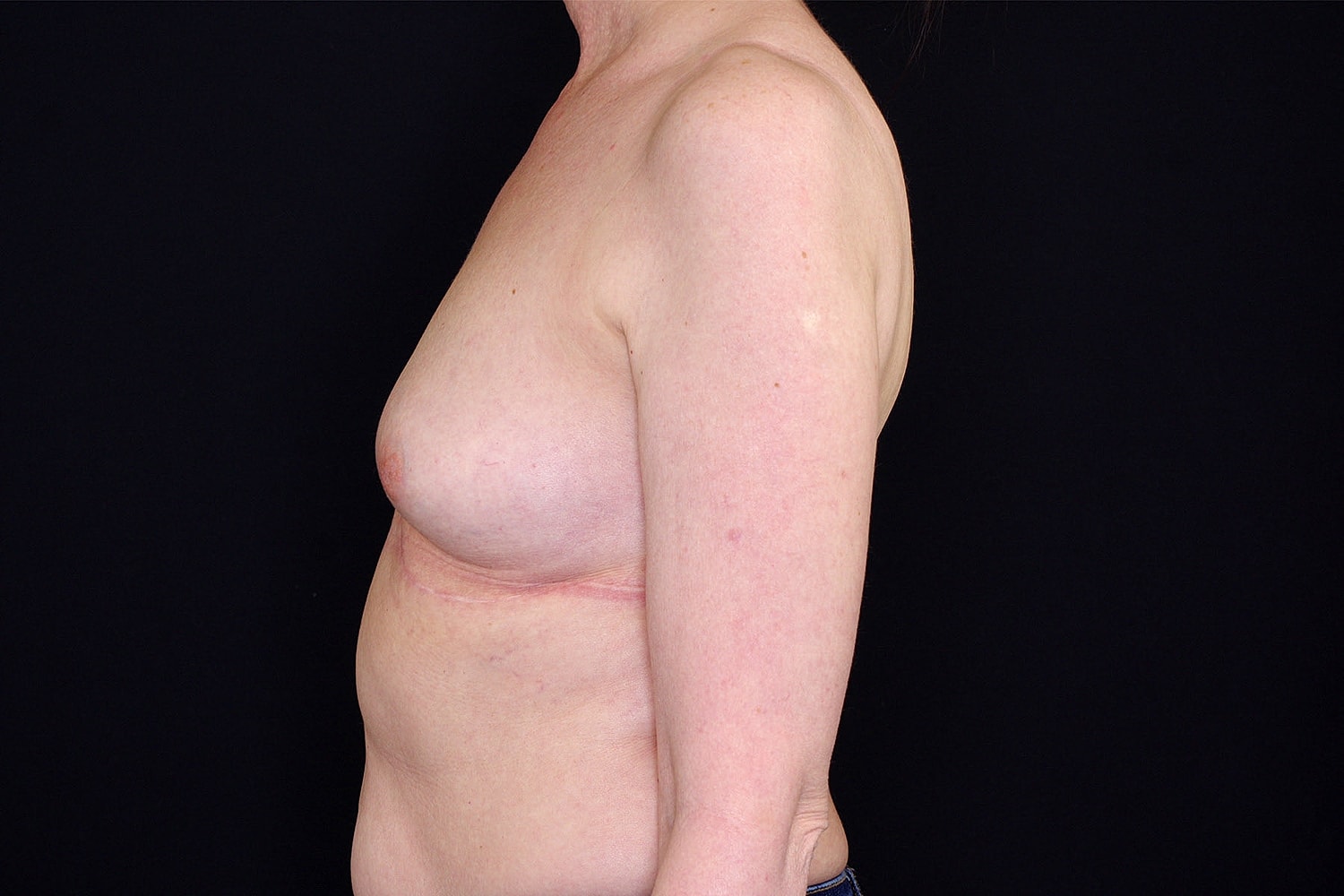 Breast Implant Removal Before & After