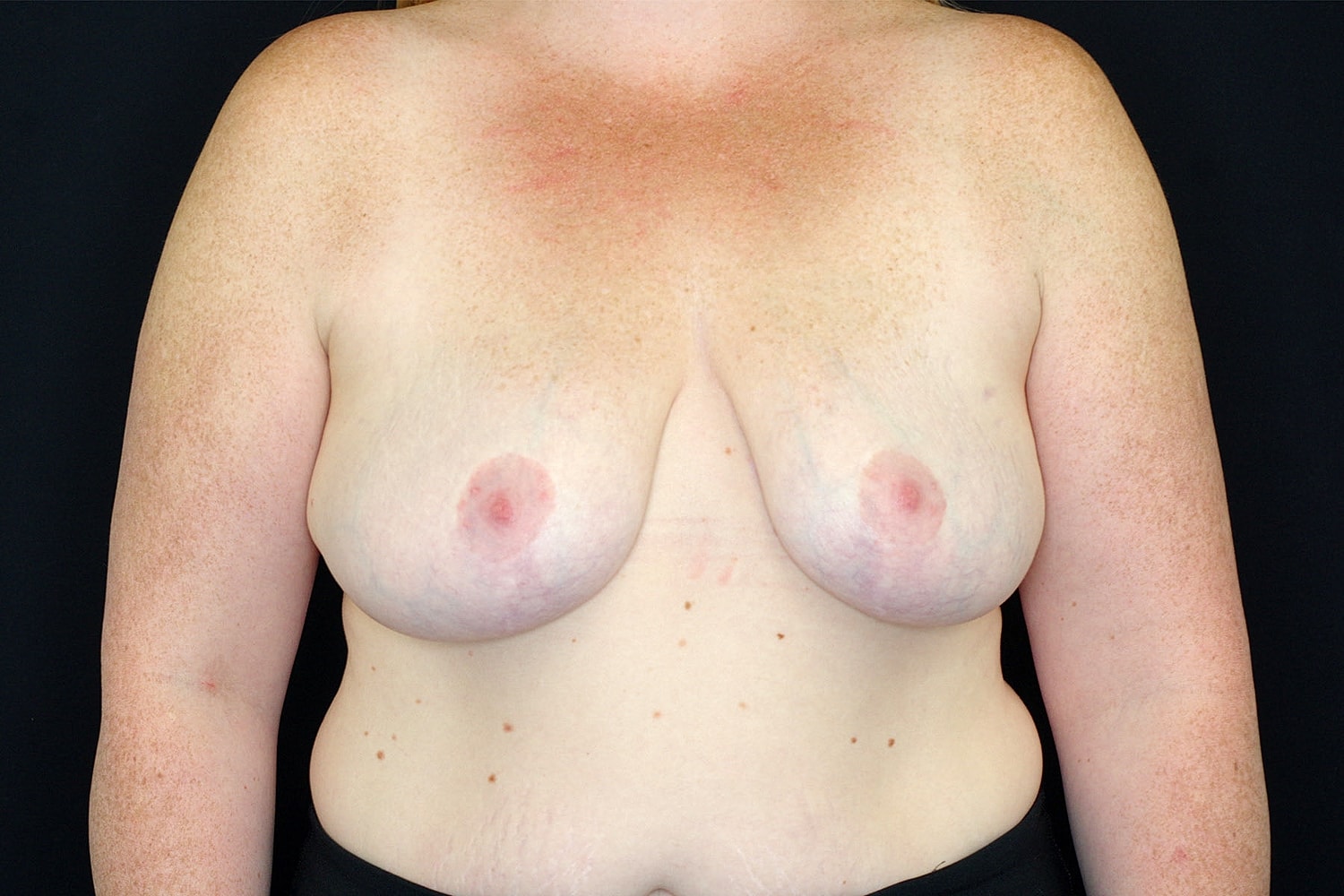 Breast Implant Removal Before & After