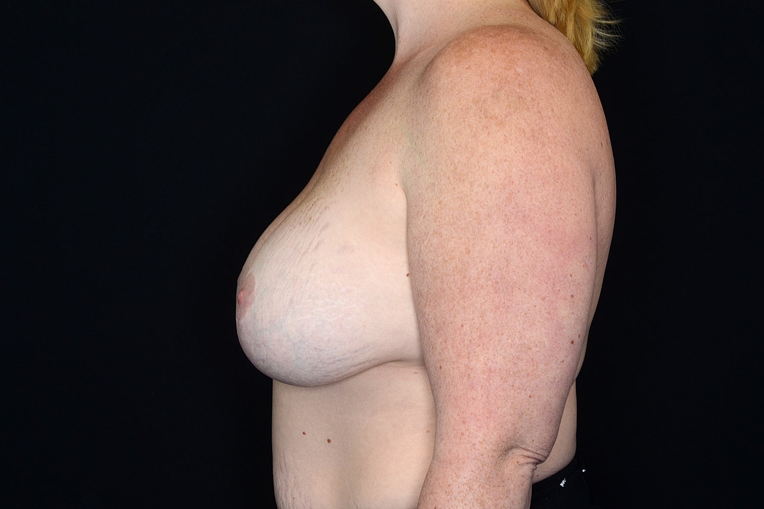 Breast Implant Removal Before & After
