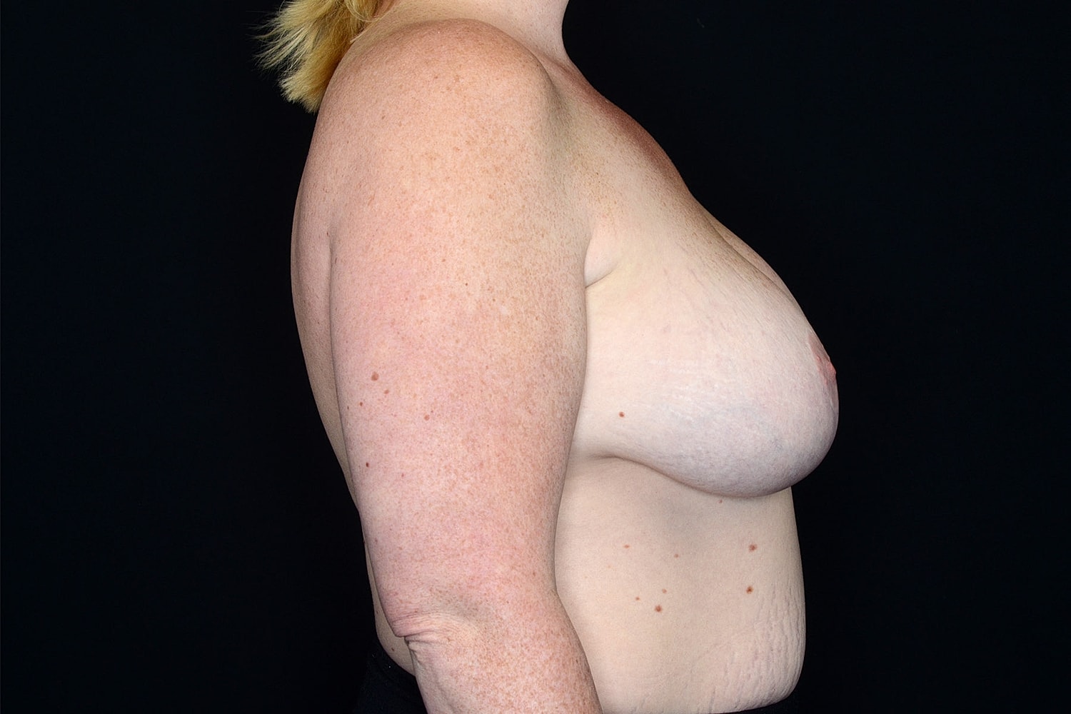 Breast Implant Removal Before & After