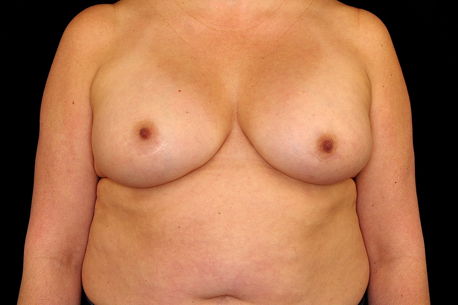 Breast Implant Removal Before & After